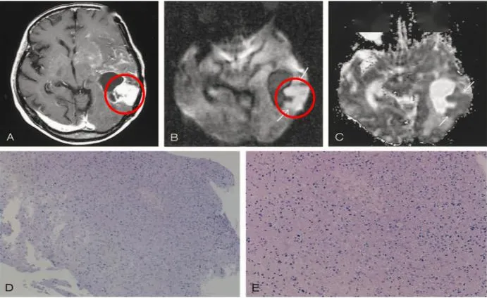 一例间变型星形细胞瘤放化疗后dwi影像及病理改变
