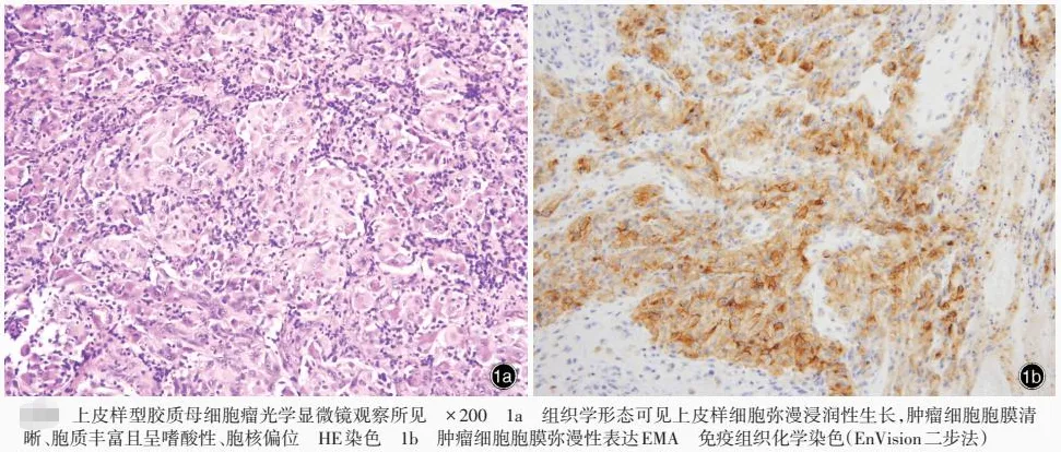 胶质母细胞瘤组织学形态