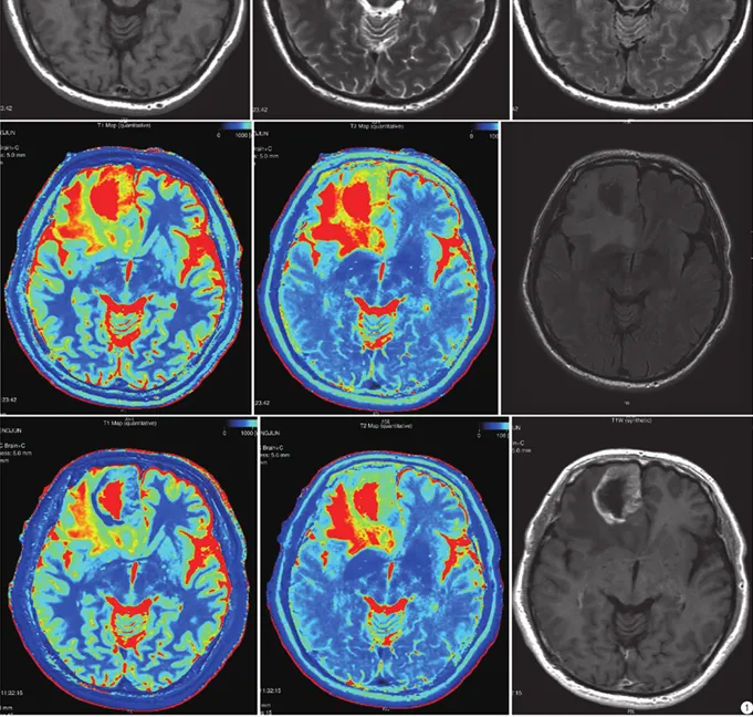 高级别胶质瘤。从左至右、从上到下分别是：合成图像（T1WI、T2WI、T2 FLAIR)；合成T1 mapping、合成T2 mapping、常规扫描T2 FLAIR；增强后合成图像（T1 mapping+C、T2 mapping+C、T1WI+C)