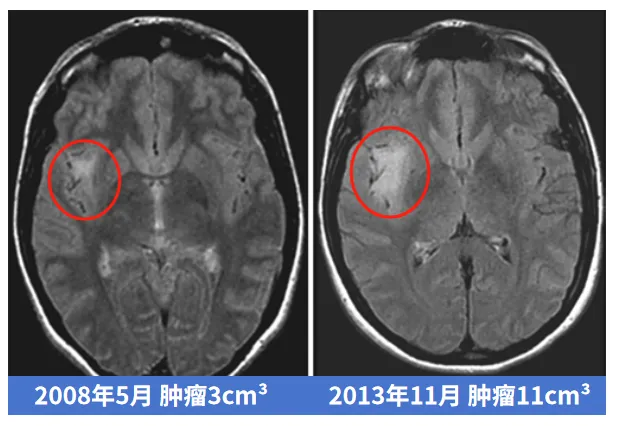 肿瘤发展进程变化图片