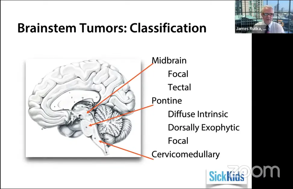 脑干肿瘤分类，Midbrain中脑—Focal局灶性、Tectal顶盖；Pontine桥脑—Diffuse Intrinsic弥漫性内生性脑桥胶质瘤(DIPG)、Dorsally Exophytic背侧外生、Focal局灶性；Cervicomedullary颈髓