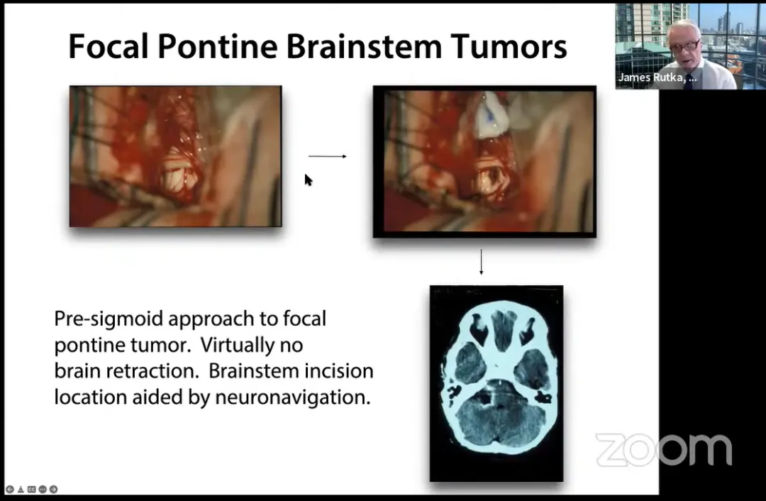 乙状窦前入路治疗脑桥局灶性肿瘤，几乎没有大脑收缩。神经导航辅助脑干切口定位