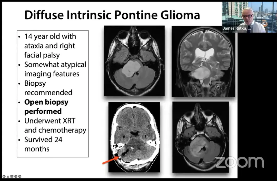 14岁，共济失调和右侧面瘫。进行开放式活检，进行XRT和化疗，幸存24个月。
