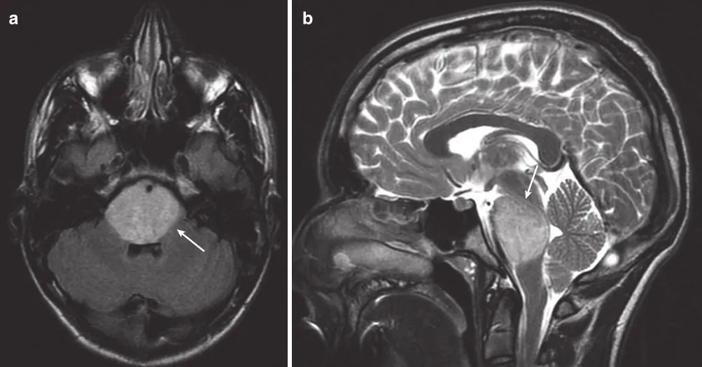 图：一名14岁男孩的MRI扫描，他有短暂的复视、共济失调和左侧面瘫。(a)轴向FLAIR MRI显示高信号占据整个脑桥（箭头）。(b)矢状T2 MRI显示DIPG使脑桥范围受累（箭头）