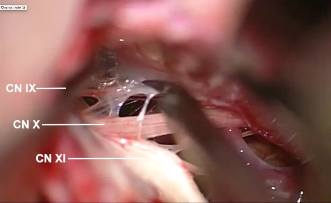 重要颅神经及血管的暴露及保护