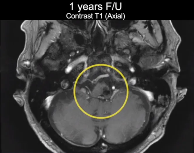 术后一年复查MR，未见复发，脑组织正常。