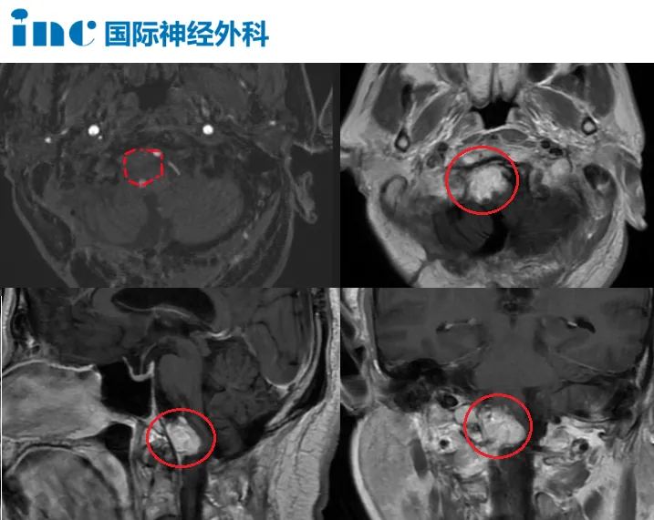 脑膜瘤