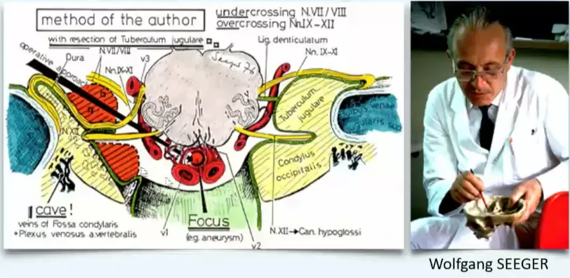 图：INC巴特朗菲教授导师Seeger教授手绘枕骨大孔区