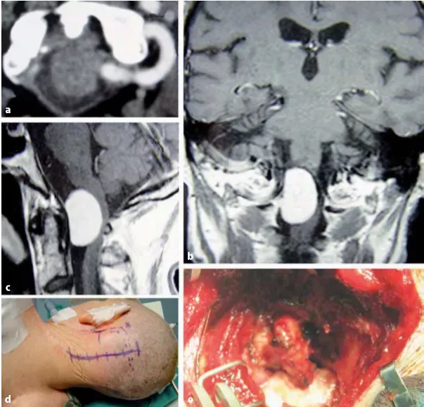 图13.15术前a-c轴位（a）、冠状位（b）和矢状位（c）图像显示69岁患者，C1水平枕大孔脑膜瘤。d肿瘤切除，病人置于右侧park-bench体位（侧俯卧位）。e暴露在椎动脉旁的的硬脑膜入口。