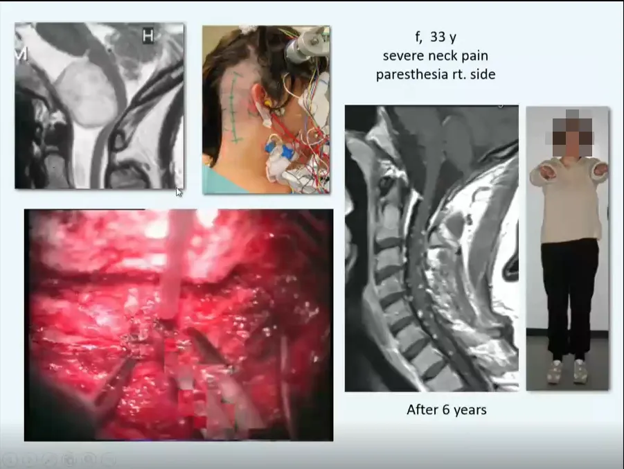 33岁女性，颈部剧烈疼痛、身体右侧感觉异常。顺利全切，术后6年未复发，状态良好。无神经功能损伤。