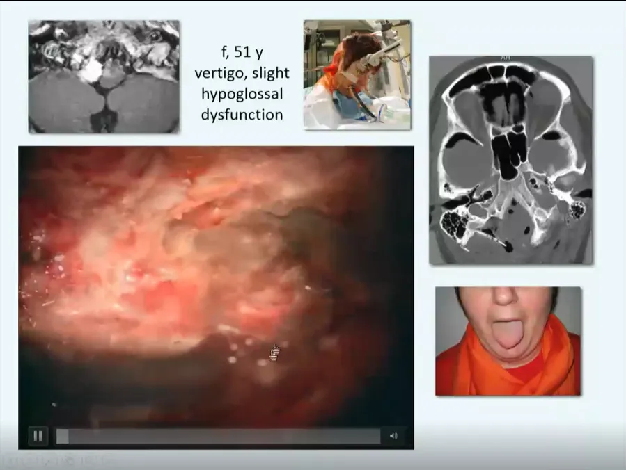 51岁女性，出现眩晕，轻微舌下神经功能障碍。顺利全切后，舌下神经功能障碍消失。