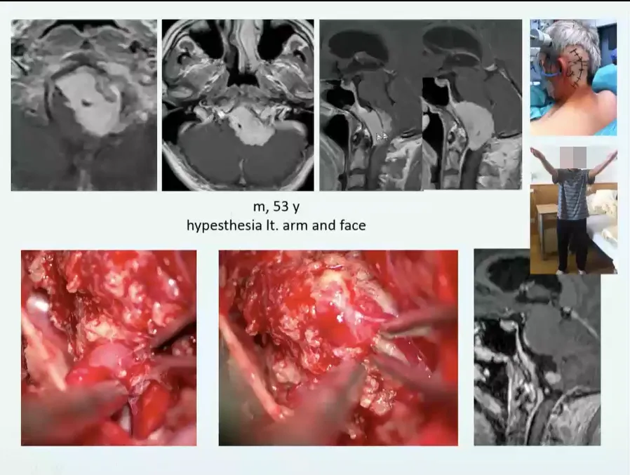 53岁男性，手臂和脸部感觉迟钝。顺利全切后，运动功能恢复，无损伤。