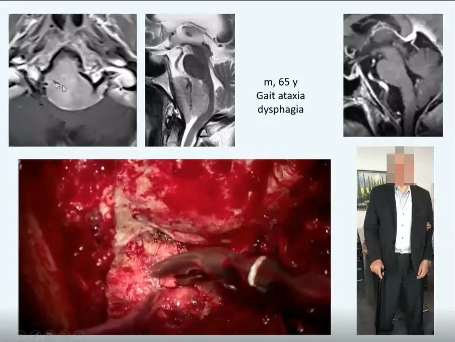 65岁男性，出现步态共济失调、吞咽困难。手术顺利全切，状态良好，无神经功能损伤。