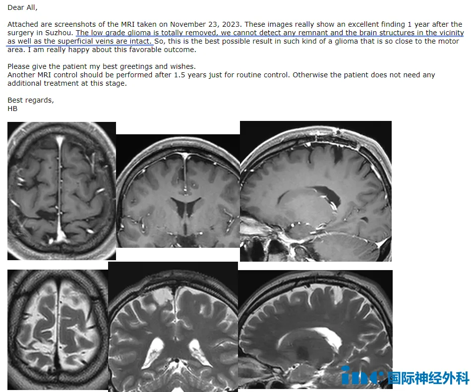 术后一年莫女士邮件随访评估中巴教授也表示：“低级别胶质瘤被完全切除，我们没有发现任何残余，附近的大脑结构和浅静脉是完整的。“