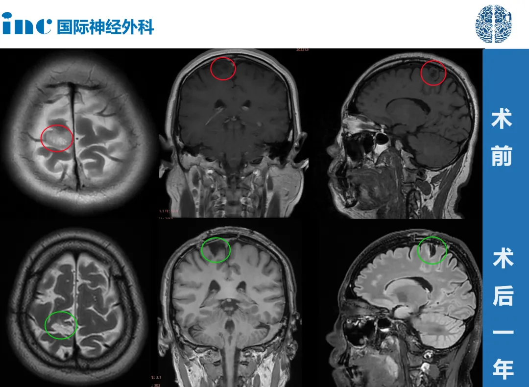 术后一年莫女士邮件随访评估中巴教授也表示：“低级别胶质瘤被完全切除，我们没有发现任何残余，附近的大脑结构和浅静脉是完整的。“