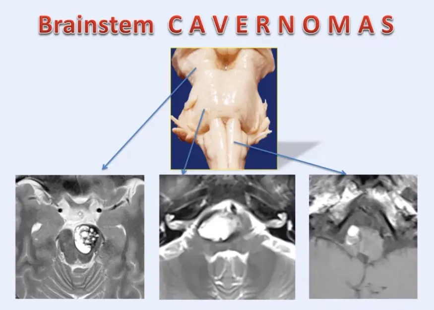 巴教授脑干海绵状血管瘤手术治疗经验要点总结