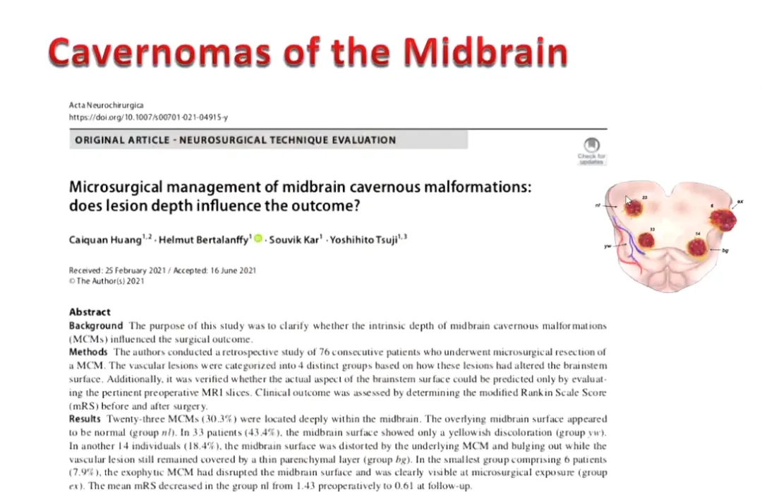 图：中脑海绵状血管瘤，巴教授根据手术差别，将中脑海绵状血管瘤分为包含4种类型，显示病变和脑干表面之间的关系。nl:内源性中脑海绵状血管瘤未突破改变中脑表面，脑干表观正常;yw:底层中脑海绵状血管瘤仅产生实质含铁血黄素沉积的中脑表面淡黄色变色;bg:内在中脑海绵状血管瘤被一层薄壁组织覆盖，但引起表面变色和中脑表面隆起;ex:外生性中脑海绵状血管瘤破坏了中脑皮层表面，从脑干处凸出