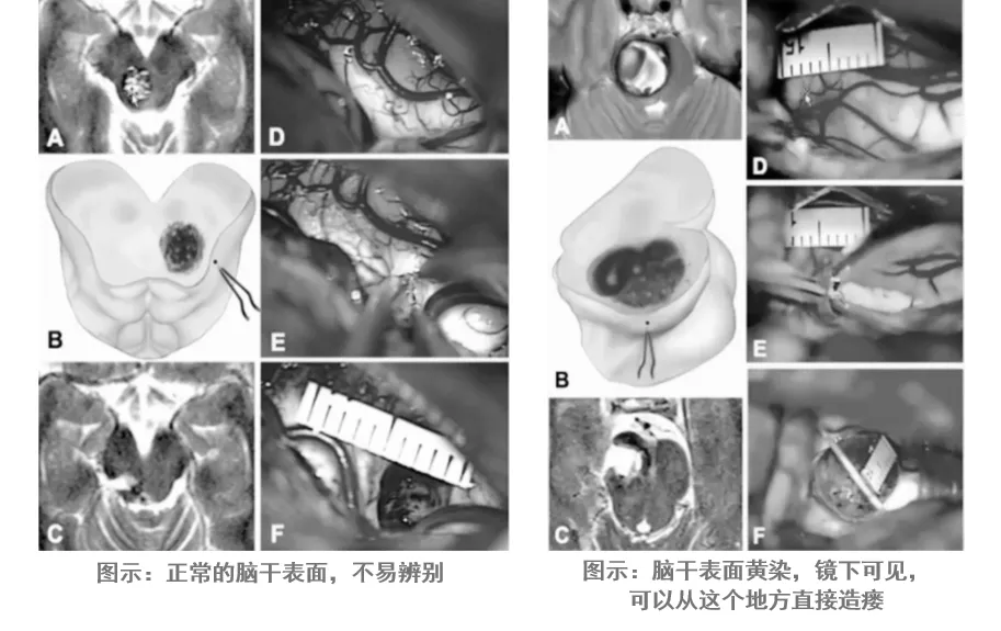 图：中脑海绵状血管瘤，巴教授根据手术差别，将中脑海绵状血管瘤分为包含4种类型，显示病变和脑干表面之间的关系。nl:内源性中脑海绵状血管瘤未突破改变中脑表面，脑干表观正常;yw:底层中脑海绵状血管瘤仅产生实质含铁血黄素沉积的中脑表面淡黄色变色;bg:内在中脑海绵状血管瘤被一层薄壁组织覆盖，但引起表面变色和中脑表面隆起;ex:外生性中脑海绵状血管瘤破坏了中脑皮层表面，从脑干处凸出