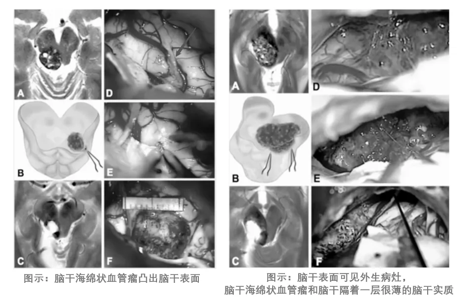 图：中脑海绵状血管瘤，巴教授根据手术差别，将中脑海绵状血管瘤分为包含4种类型，显示病变和脑干表面之间的关系。nl:内源性中脑海绵状血管瘤未突破改变中脑表面，脑干表观正常;yw:底层中脑海绵状血管瘤仅产生实质含铁血黄素沉积的中脑表面淡黄色变色;bg:内在中脑海绵状血管瘤被一层薄壁组织覆盖，但引起表面变色和中脑表面隆起;ex:外生性中脑海绵状血管瘤破坏了中脑皮层表面，从脑干处凸出