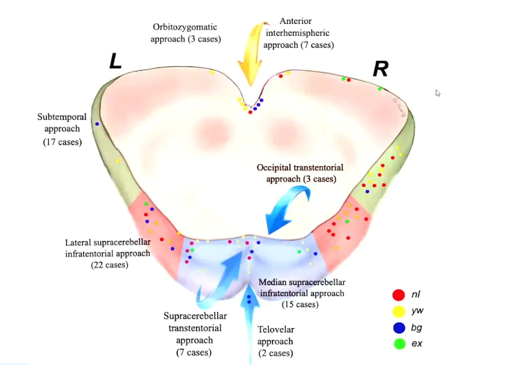 图：INC巴教授论文中展示了在中脑中使用的各种手术入路所获得的中脑暴露区域。每个点表示手术中脑孔的近似中心，中脑孔被用作进入脑干的入口点。点的颜色对应于颜色图例中所示的4种病变类型之一。右侧颞下入路更常用于进入中脑海绵状血管瘤，以避免损伤显性颞叶的风险