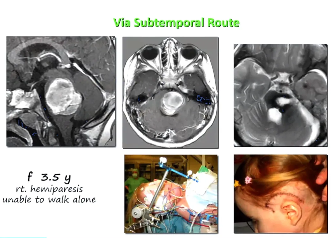 示范案例：3岁半的女孩，巨大血肿，通过颞下入路进入桥脑的侧面，血肿最终清除，桥脑后方的结构是完全保留的，这是非常重要的。