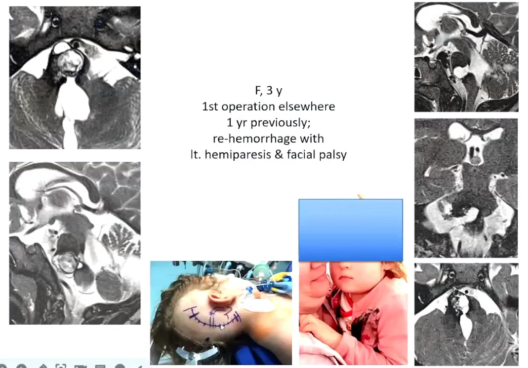 示范案例：3岁孩子，已经在其他地方做过一次手术，有一部分病灶没有切除。出现外展神经麻痹和面瘫。最终为其全切，孩子预后良好。