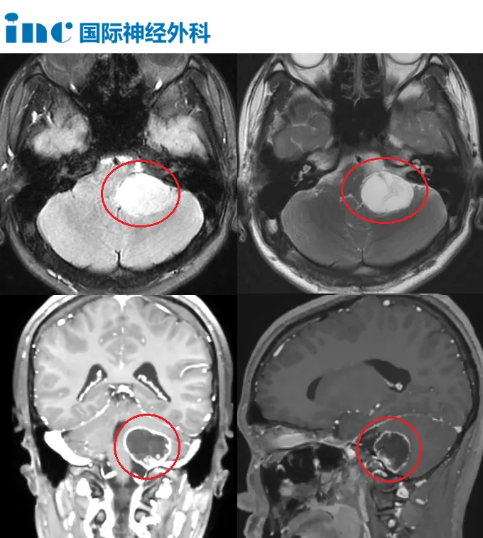 颈静脉孔区肿瘤导致声音嘶哑、听力下降……15岁男孩无畏迎战