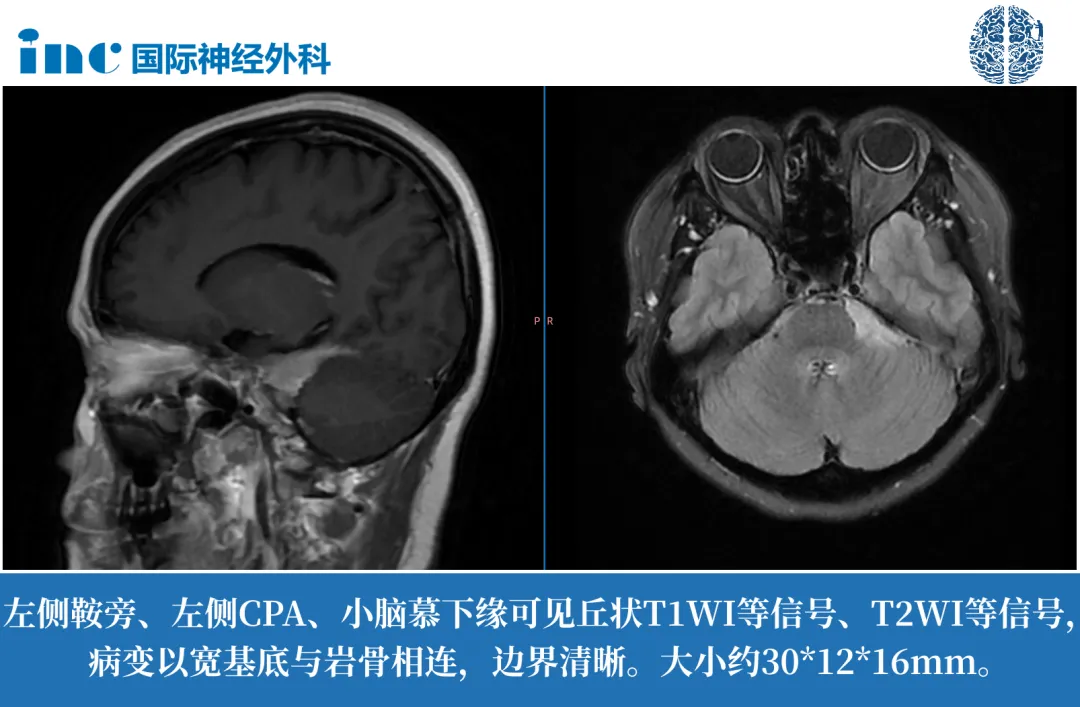 左侧鞍旁、左侧CPA、小脑幕下缘占位脑膜瘤案例：经常头痛出现这些变化，危险可能已靠近…