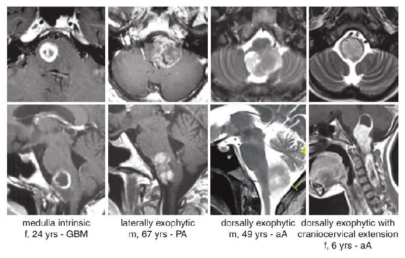 MRI显示不同性质的延髓肿瘤的经典生长位置，其中，aA为间变性星形细胞瘤，GBM为胶质母细胞瘤，PA为毛细胞星形细胞瘤。