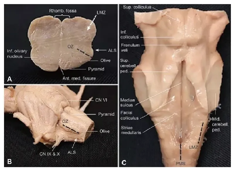 延髓的手术安全操作区。A，延髓横断面示有3个手术安全操作区：前外侧沟，橄榄区及延髓后外侧沟；B，延髓前外侧观，示进入橄榄区和前外侧沟的区域，紧位于舌下神经根下方；C，后面观示后正中沟和后外侧沟手术安全操作区。