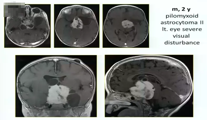 2岁男孩，毛状黏液样星形细胞瘤2级，严重的左侧视觉障碍，肿瘤巨大