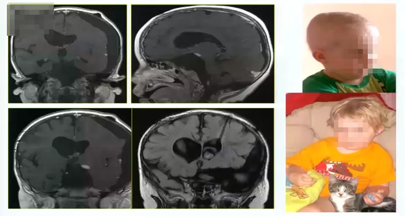 2岁男孩，毛状黏液样星形细胞瘤2级，严重的左侧视觉障碍，肿瘤巨大