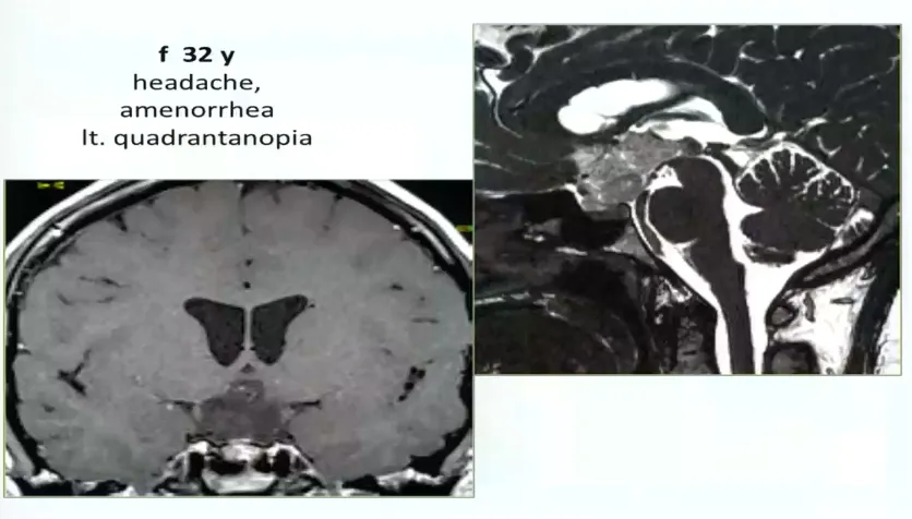 32岁女性，头疼、闭经、视野缺损，左侧视野象限盲，累及视路后部、下丘脑，脚前窝。病变完全位于中线，因此采用前纵裂入路。手术最终顺利全切。