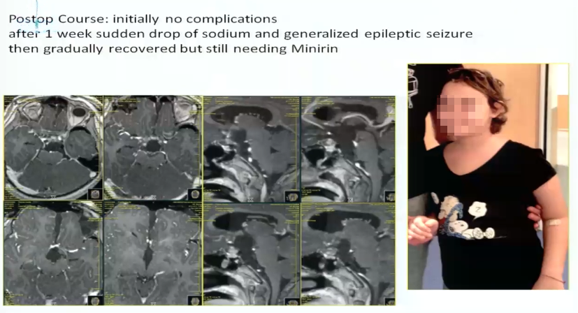 术后情况：术后出现并发症，血钠下降非常厉害，术后一周还出现癫痫大发作。通过内科治疗，逐渐恢复。因此巴特朗菲教授表示一定要注意病人术后血钠水平和激素水平的变化。