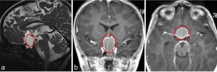 a–c图MR成像显示囊性病变对比增强，高度怀疑颅咽管瘤