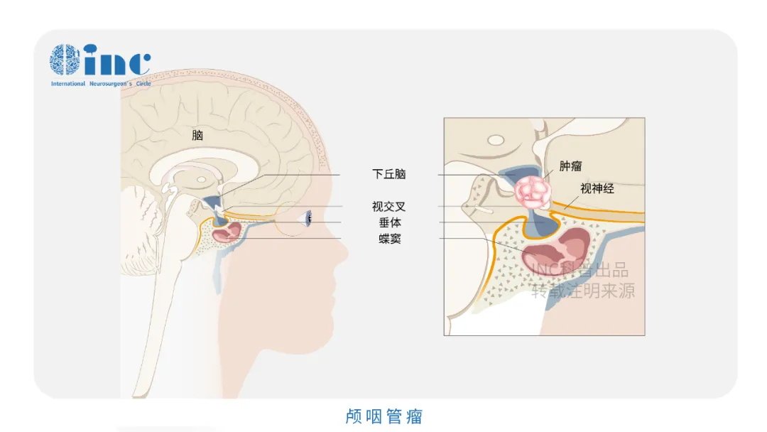 鞍上颅咽管瘤开颅和经鼻内镜手术