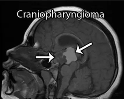鞍上颅咽管瘤开颅和经鼻内镜手术