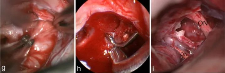 g图中，使用镊子的双向牵拉技巧解剖分离肿瘤；h图中，肿瘤（T）在30°神经内窥镜视野下正常显微镜难以显示；i图中，最终检查显示肿瘤全切除和视神经完整保留（ON）