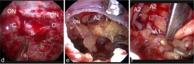 d图中，经鼻内镜手术入路暴露。视神经的隆起（ON）可以看到总颈动脉（C）和鞍状硬脑膜（S）。e图表示切除之后肿瘤隆起，肿瘤上表面暴露在30°内窥镜下观察。右前A2节段可见脑动脉和右视神经（ON）。f图中，从视交叉切开肿瘤，使用镊子双向牵拉分离暴露（视神经ON）、A1和前脑动脉的A2段（A1，A2）。