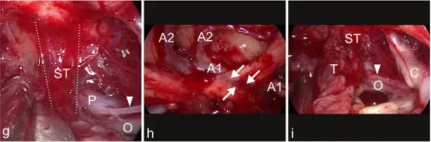 g图表示背侧肿瘤表面，垂体柄浸润（ST，在虚线）被可视化处理眼动脉（O），后交通动脉P1段（P）和后交通动脉（箭头）。h图表示肿瘤切除后，左视神经内出现严重的压迹（箭头），由于肿瘤对神经的压迫和A1区段引起的可以看到大脑前动脉（A1和A2）。i图中，最终检查显示垂体后叶浸润（ST）后部、交通动脉（箭头）、岩上段颈内动脉（C）和动眼神经（O）的肿瘤残留（T）
