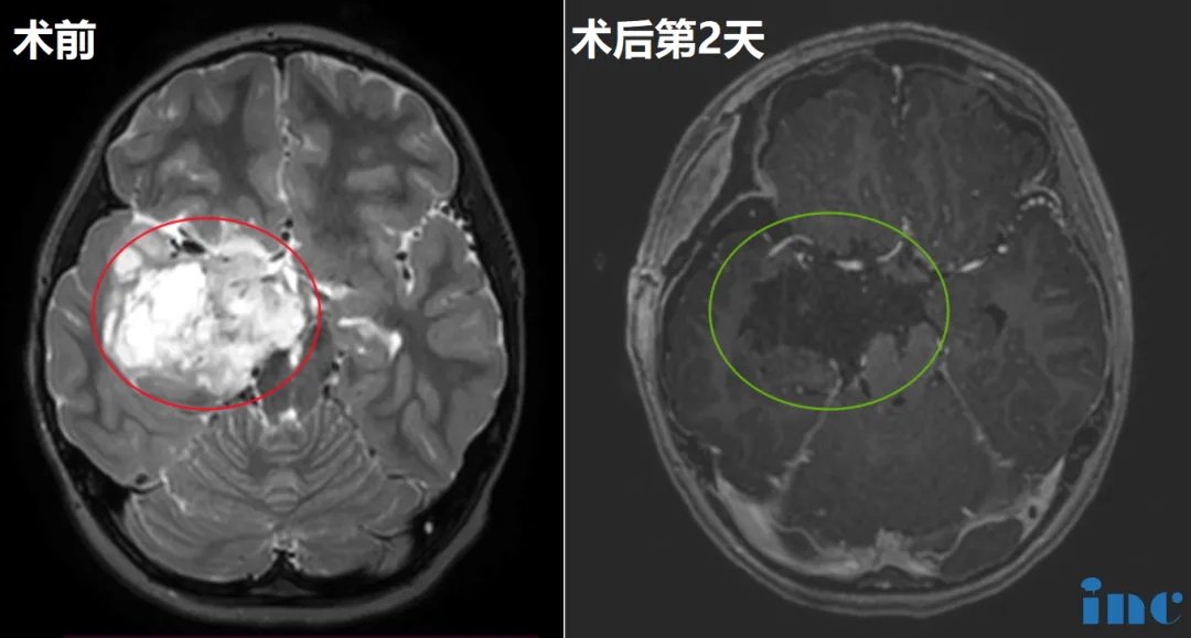 可可术前术后影像对比