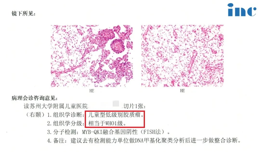 可可的活检结果