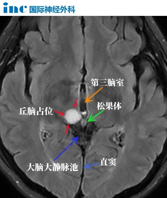 丘脑胶质瘤到底能不能手术？