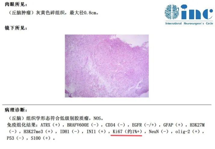 病理结果出来了，低级别胶质瘤！  　　Ki67约1%