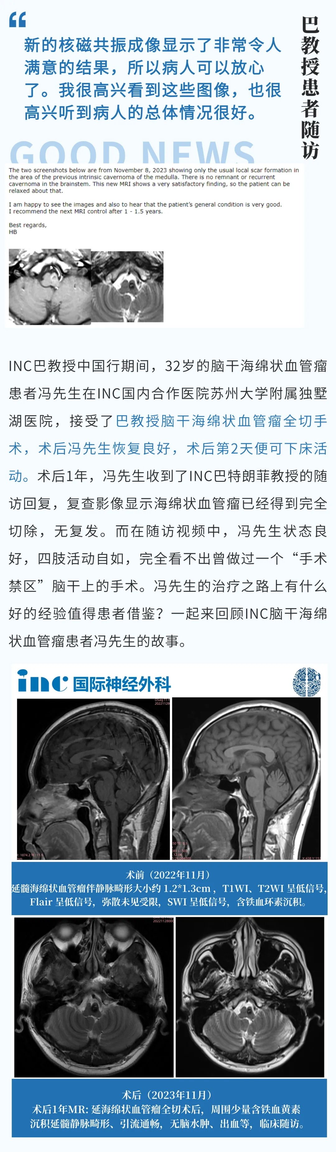 32岁脑干-延髓海绵状血管瘤患者冯先生