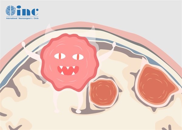 二级脑膜瘤是恶性还是良性？