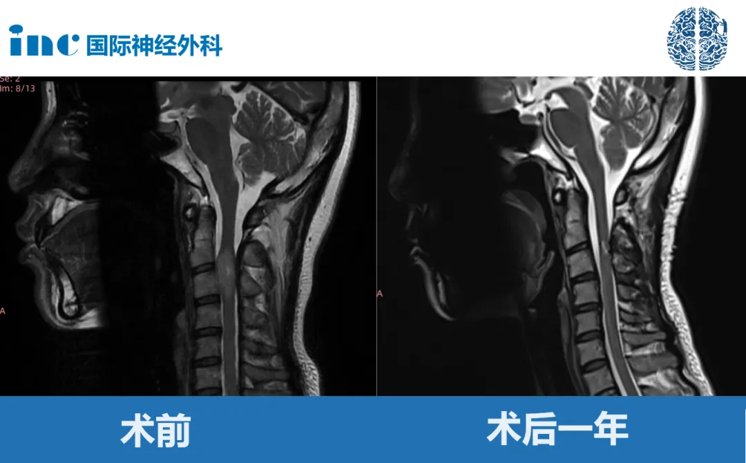 潇潇术后一核磁影像