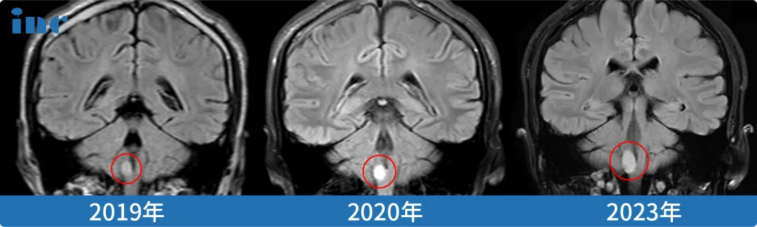 脑干延髓胶质瘤手术案例影像2019-2023