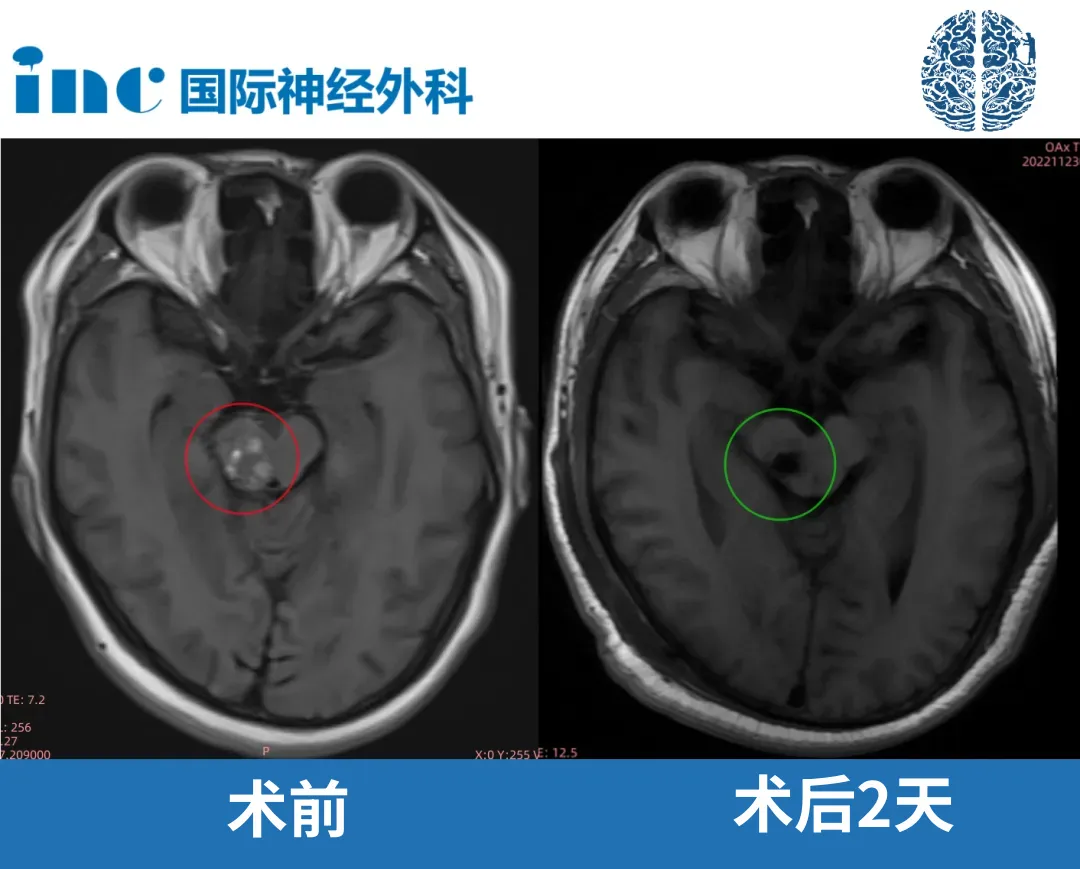 显微镜下，脑干海绵状血管瘤取出过程