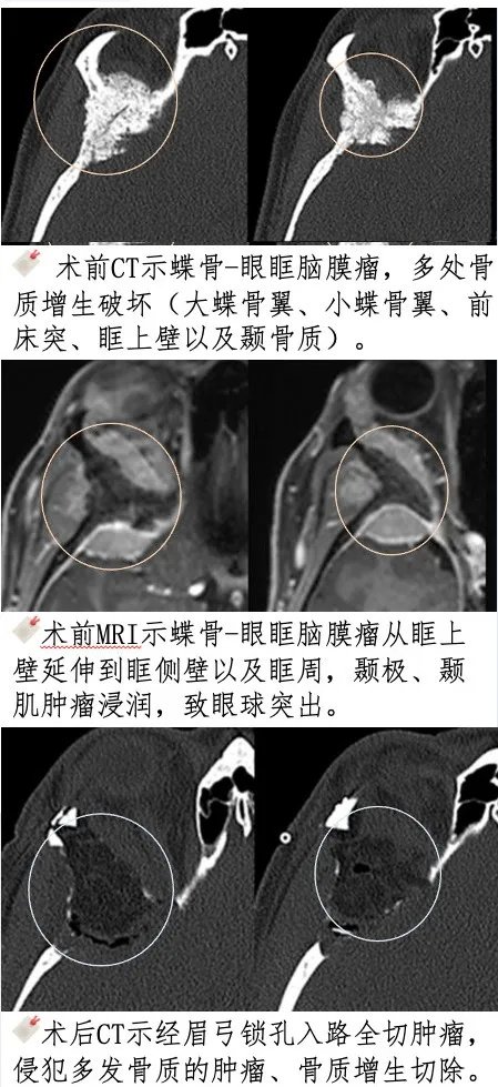 38岁女性蝶眶脑膜瘤致眼球突出